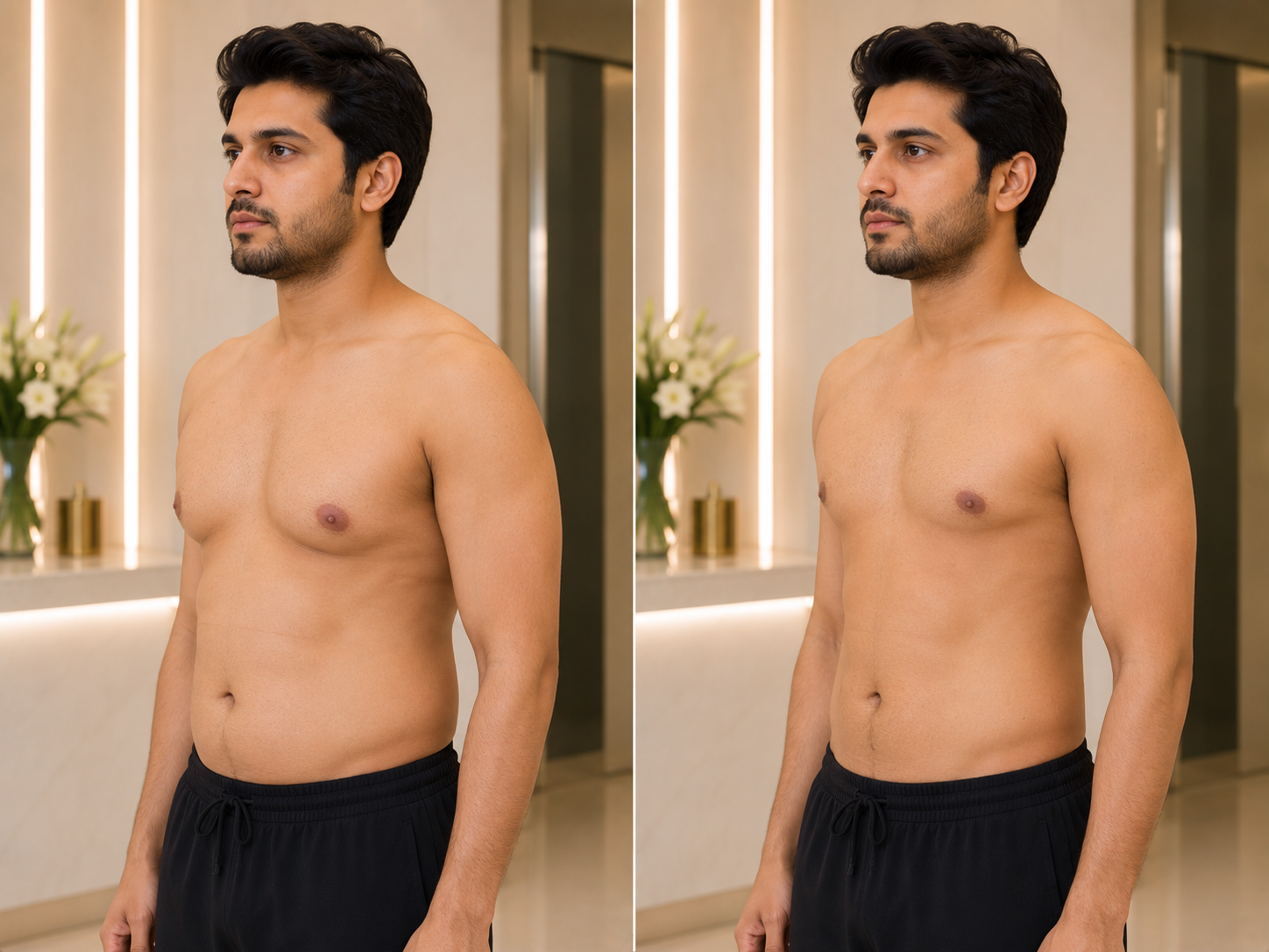 Gynecomastia Surgery
