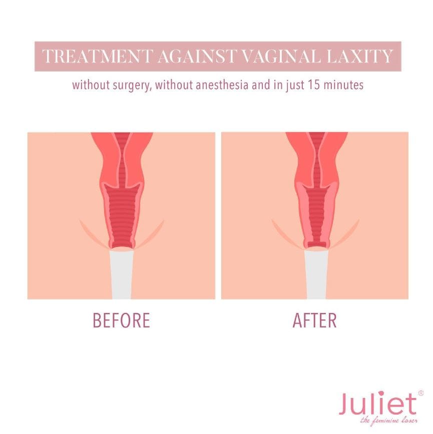 Laser Vaginal Tightening