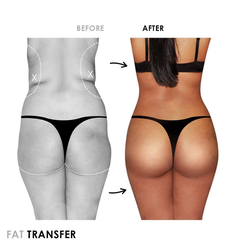 Fat Transfer (Face, Breast, Buttock)