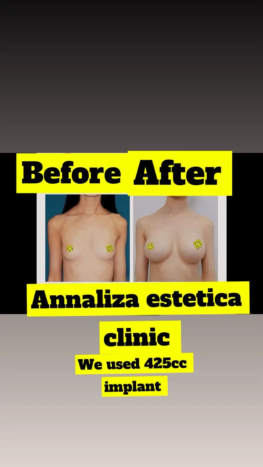 Plastic & Cosmetic Procedures treatment result at Annaliza Estetica Clinic Islamabad
