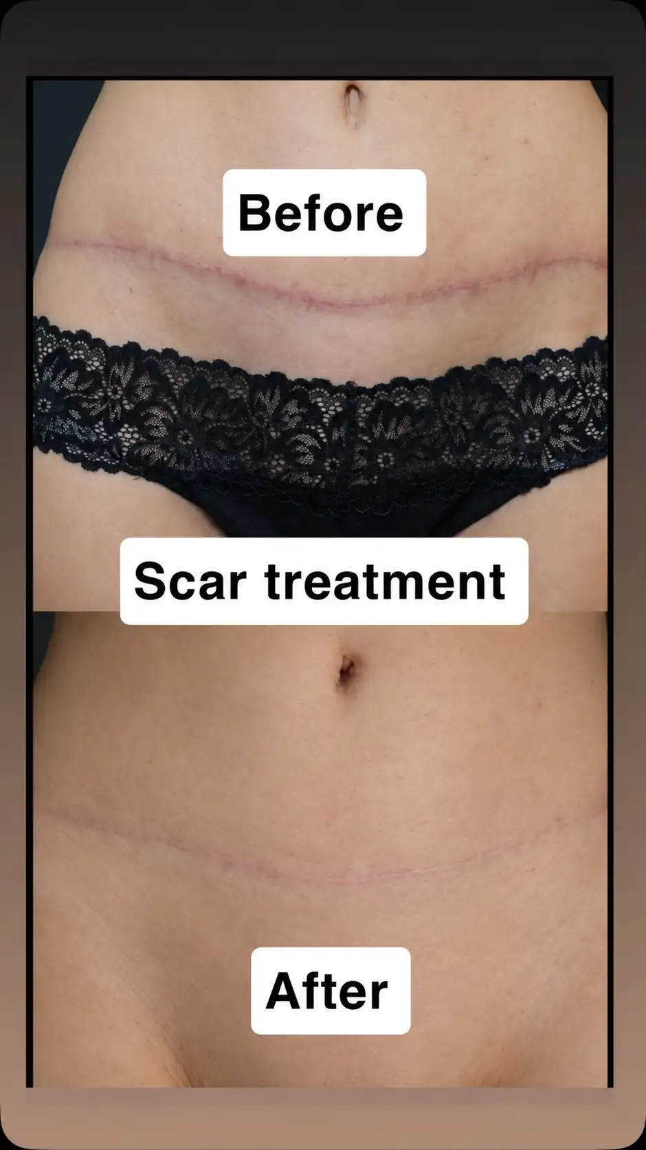 Skin Rejuvenation treatment result at Annaliza Estetica Clinic Islamabad