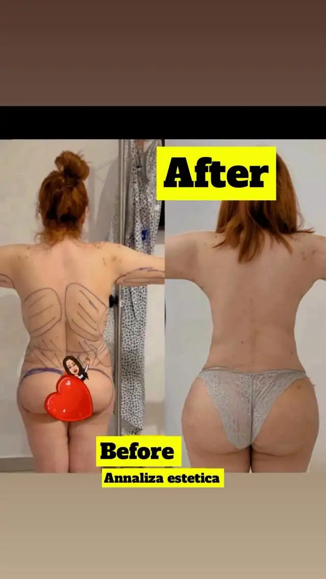 Plastic & Cosmetic Procedures treatment result at Annaliza Estetica Clinic Islamabad