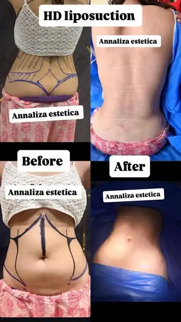 Before and after treatment result