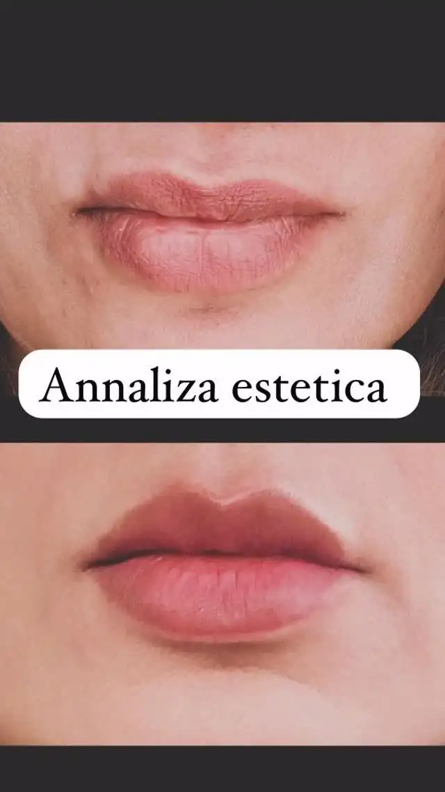 Dermal Fillers treatment result at Annaliza Estetica Clinic Islamabad